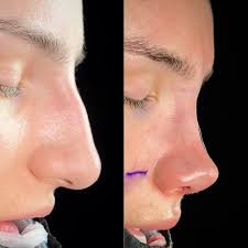 Rhinoplasty in Dubai