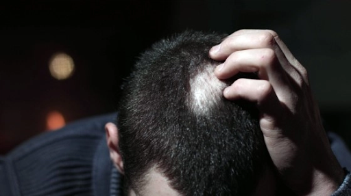 Hairline